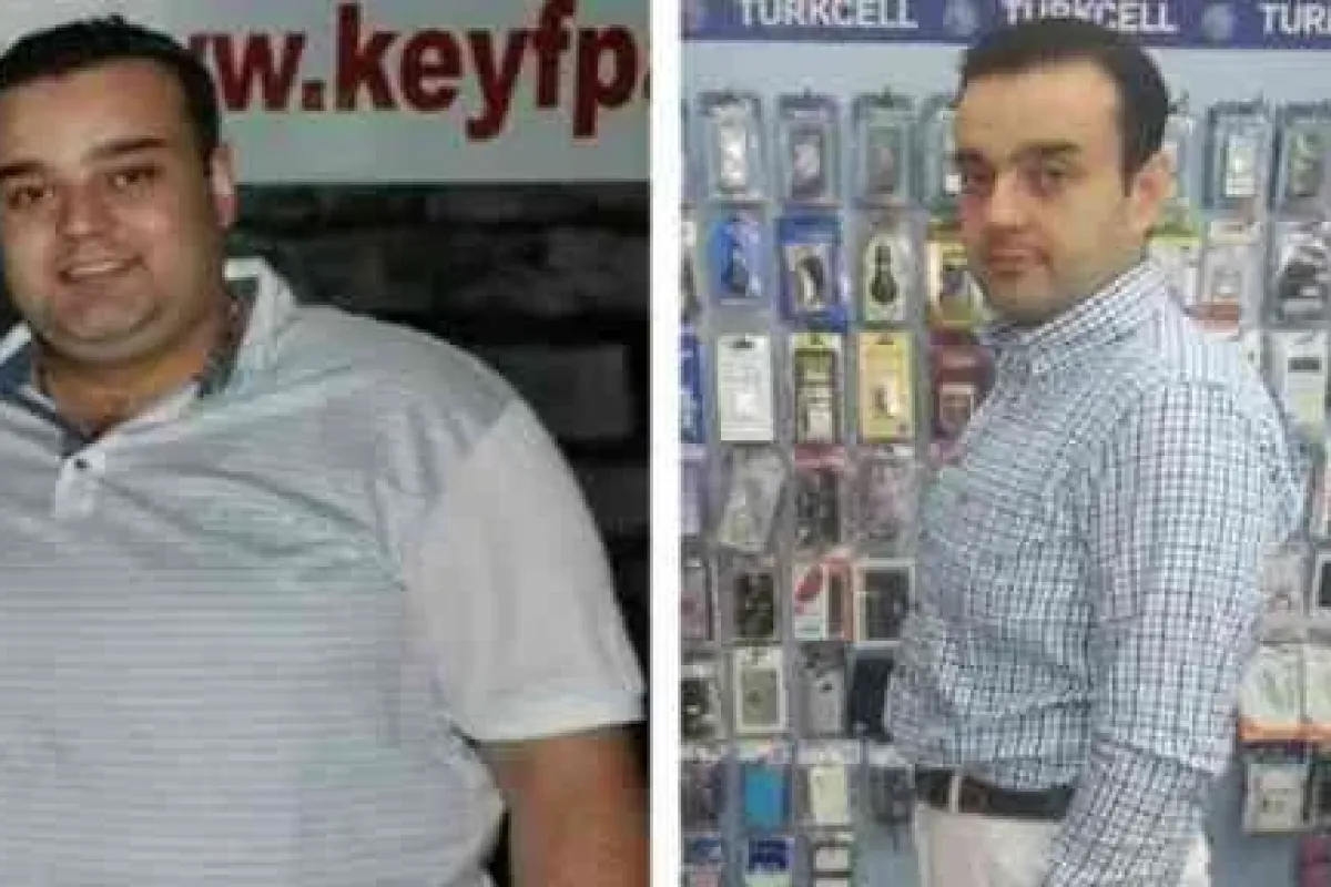 Tüp Mide Ameliyatıyla Obeziteye Son !