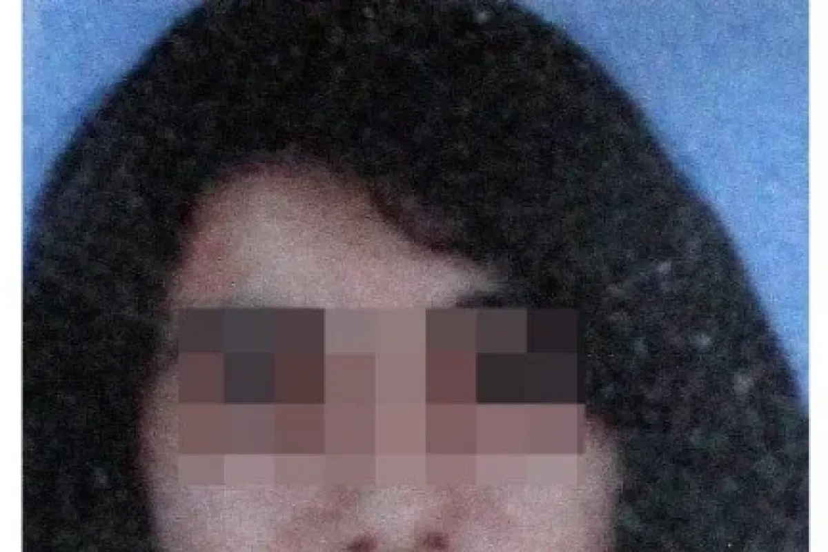 Yüzündeki Yanık Izi Sonu Oldu