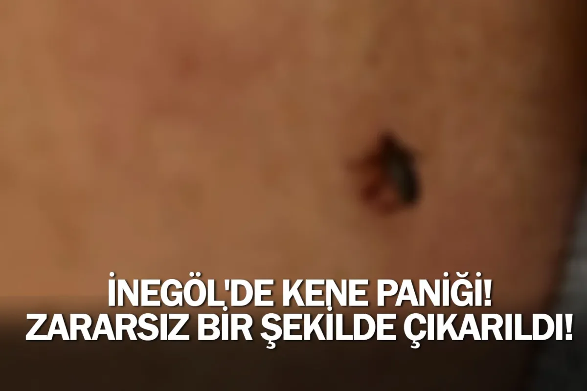 İnegöl'de kene paniği! Zararsız bir şekilde çıkarıldı!