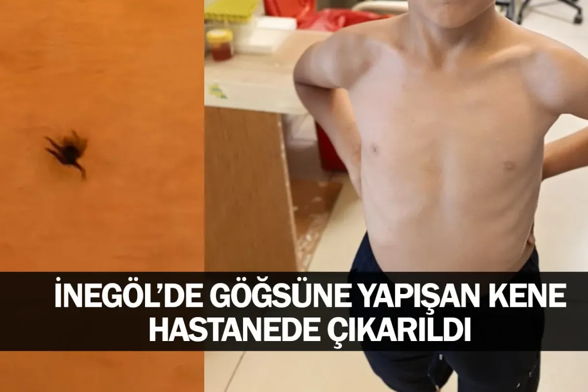 Göğsüne yapışan kene hastanede çıkarıldı