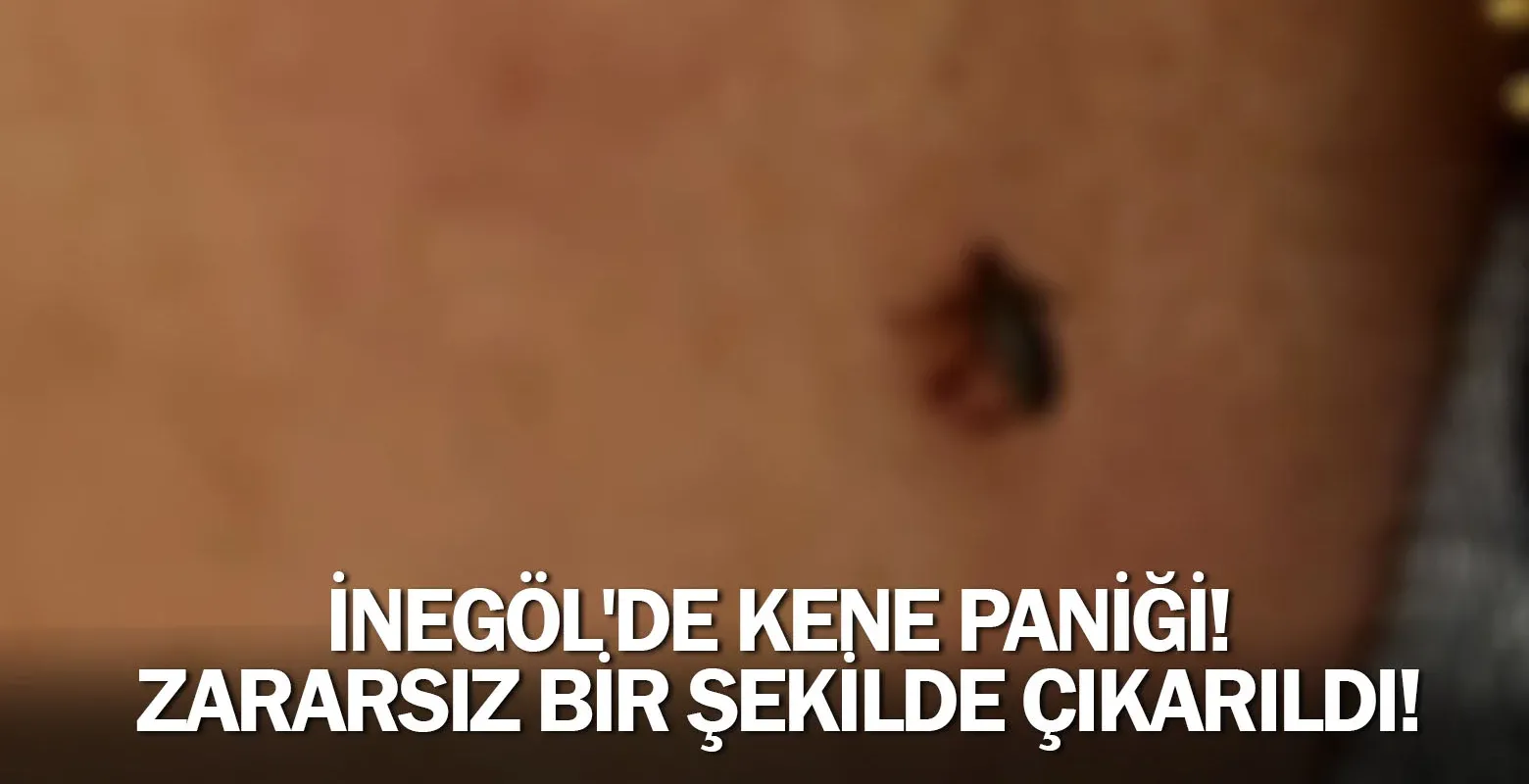 İnegöl'de kene paniği! Zararsız bir şekilde çıkarıldı!