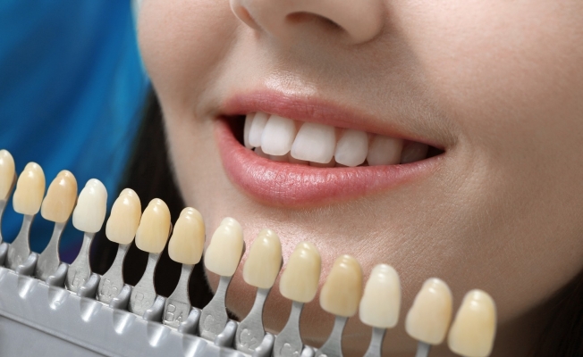 Dişleri beyazlatmada sosyal medya önerileri sağlığınıza zarar verebilir