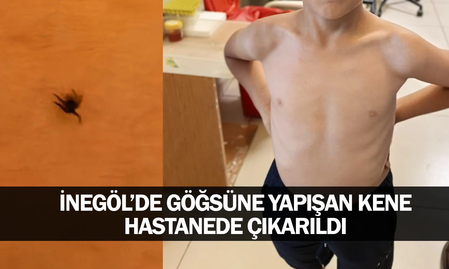 Göğsüne yapışan kene hastanede çıkarıldı